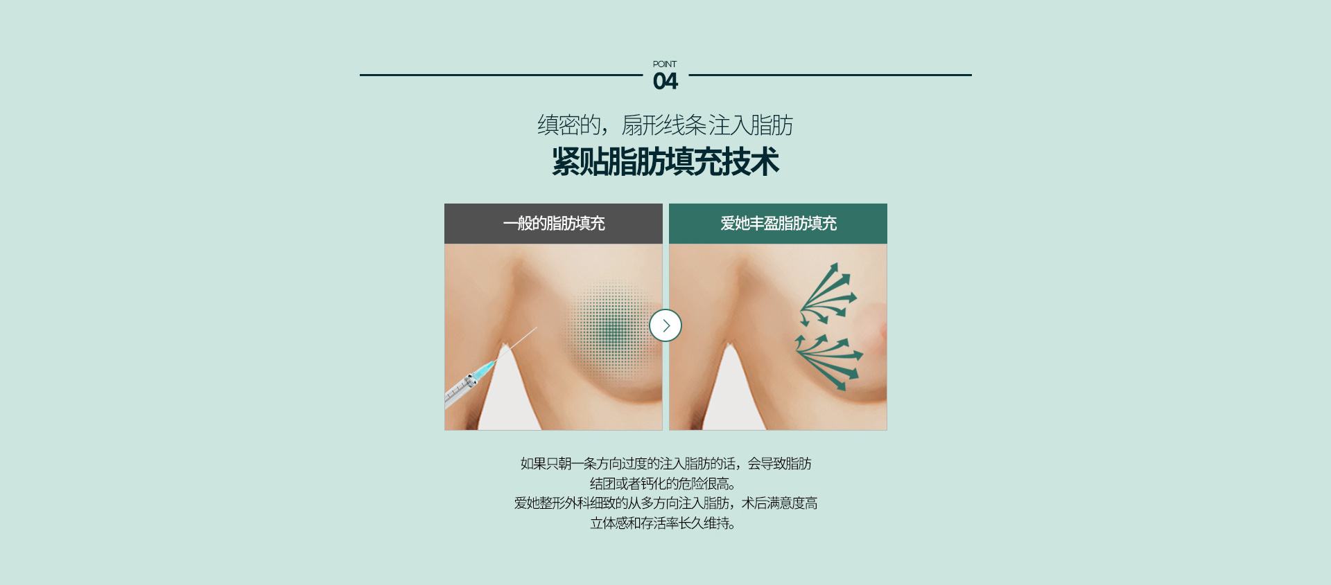 가슴지방이식