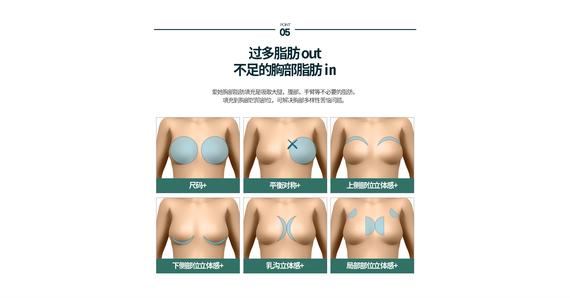 가슴지방이식
