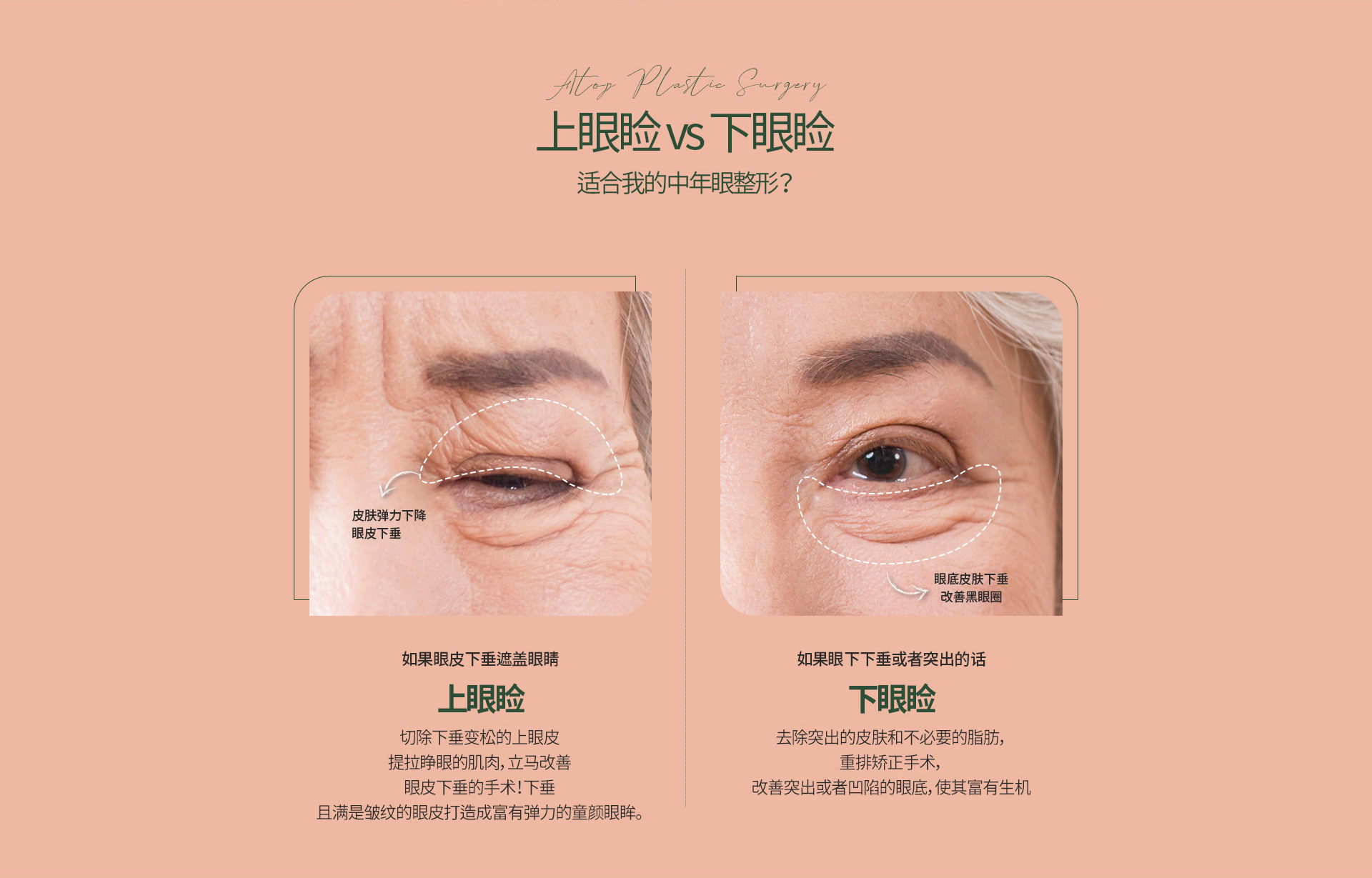 중년눈성형