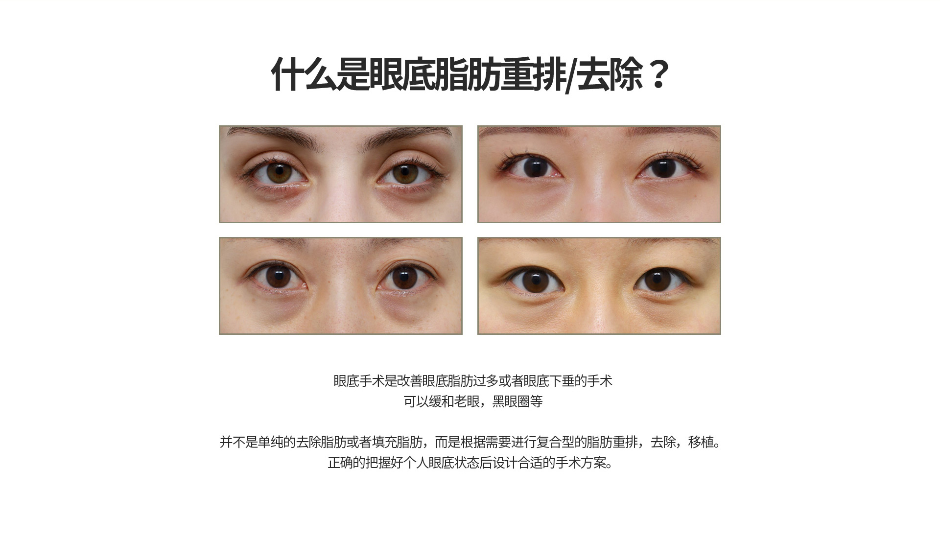 눈밑지방재배치/제거
