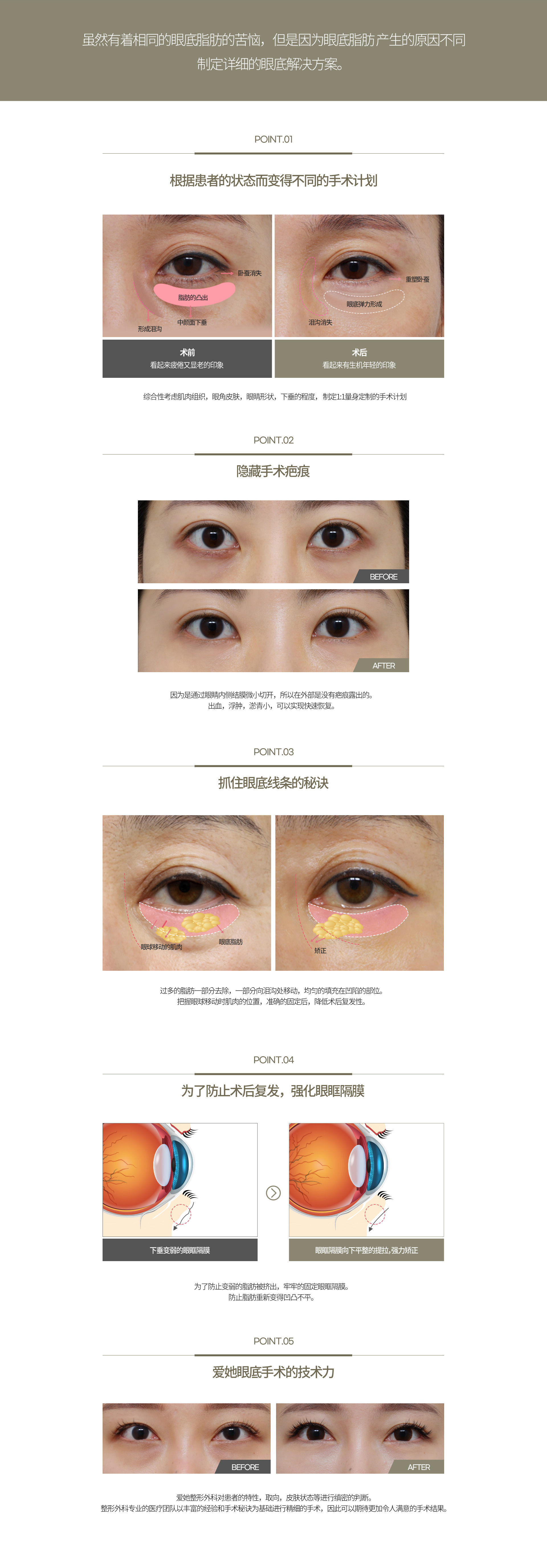 눈밑지방재배치/제거