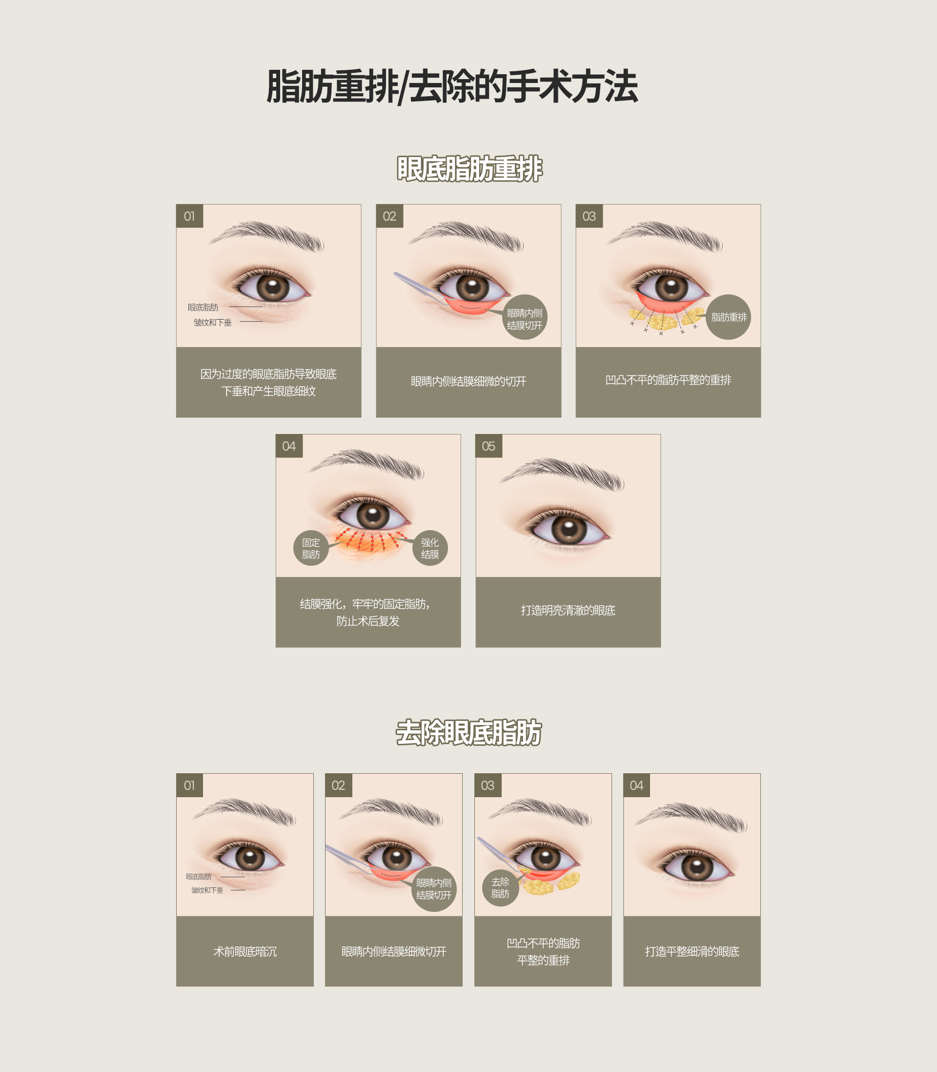 눈밑지방재배치/제거