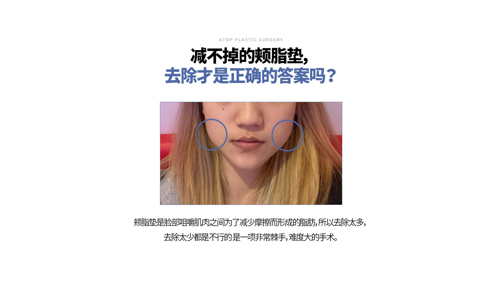 심부볼 지방 재배치
