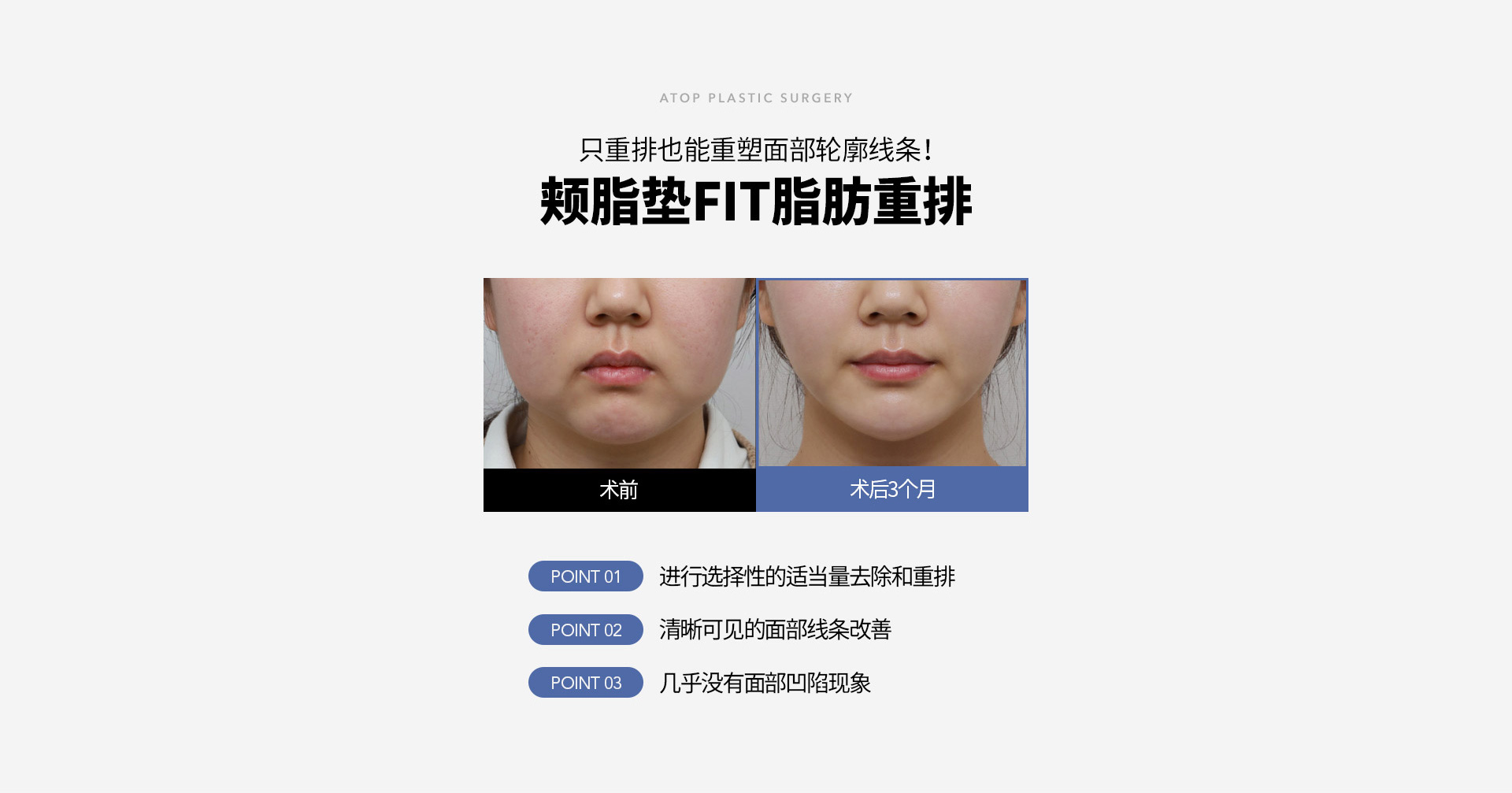 심부볼 지방 재배치