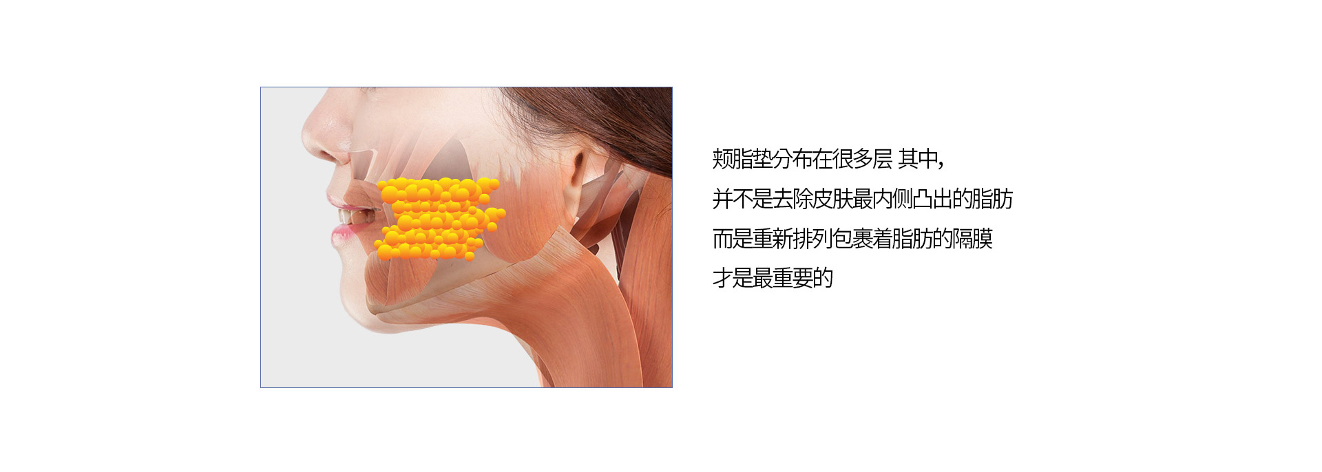 심부볼 지방 재배치