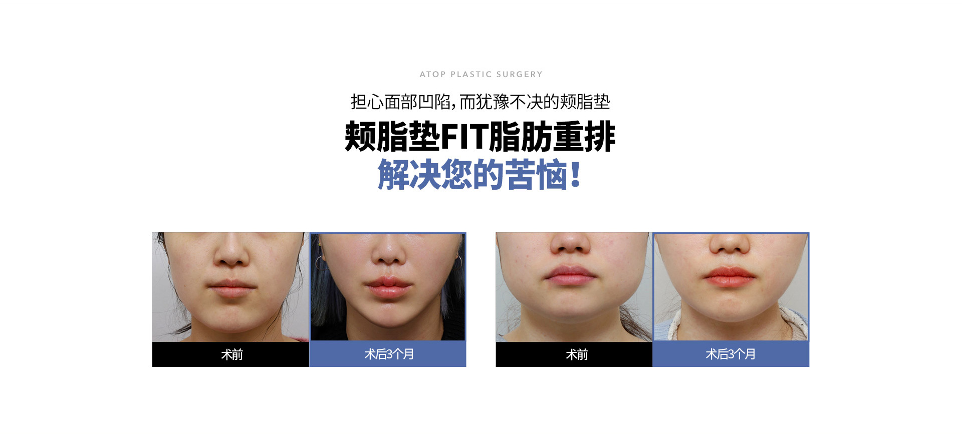 심부볼 지방 재배치