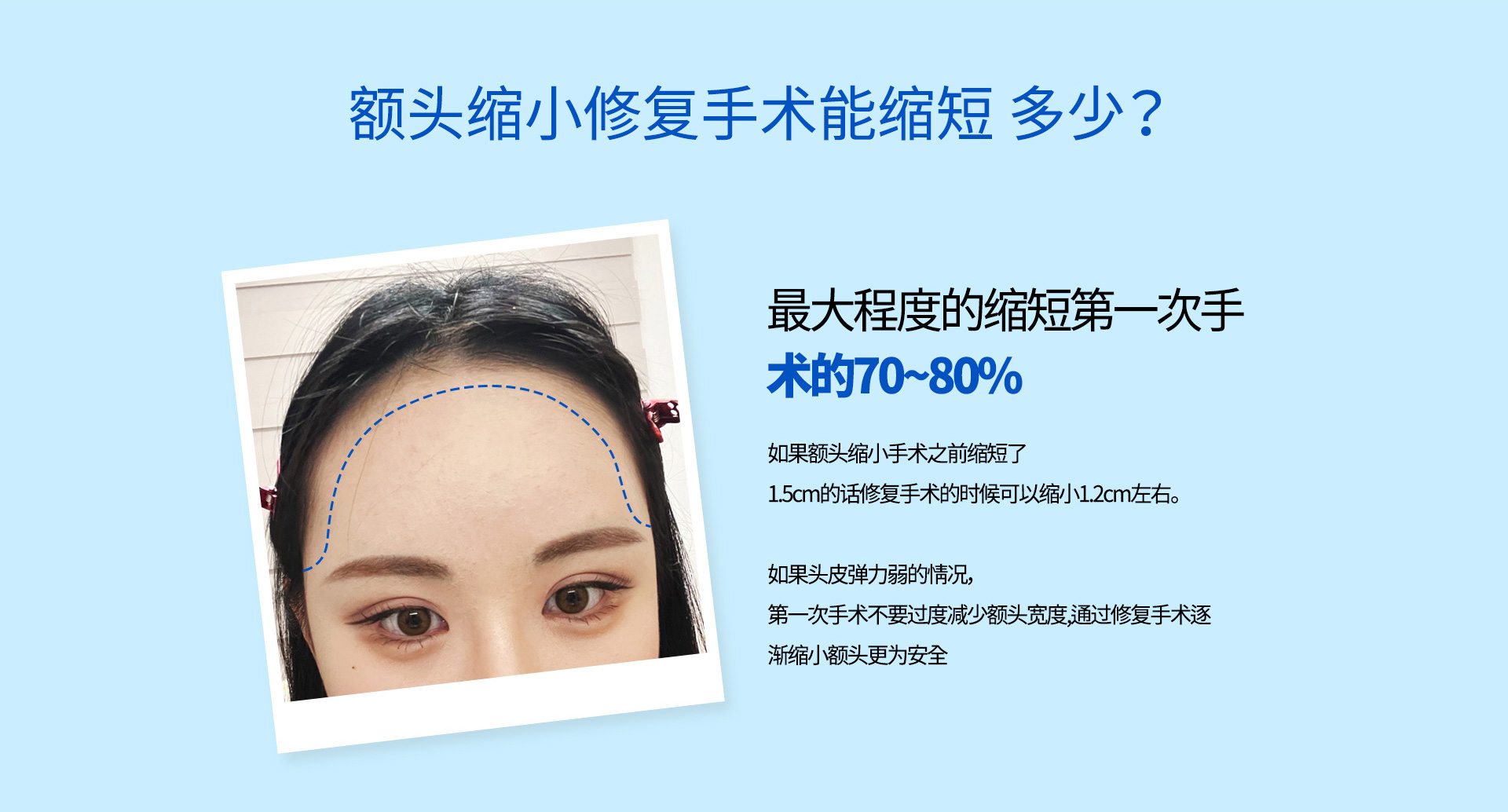 이마축소 재수술
