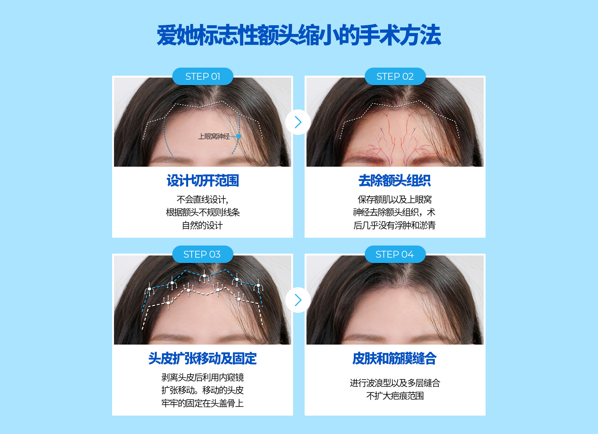이마축소 재수술