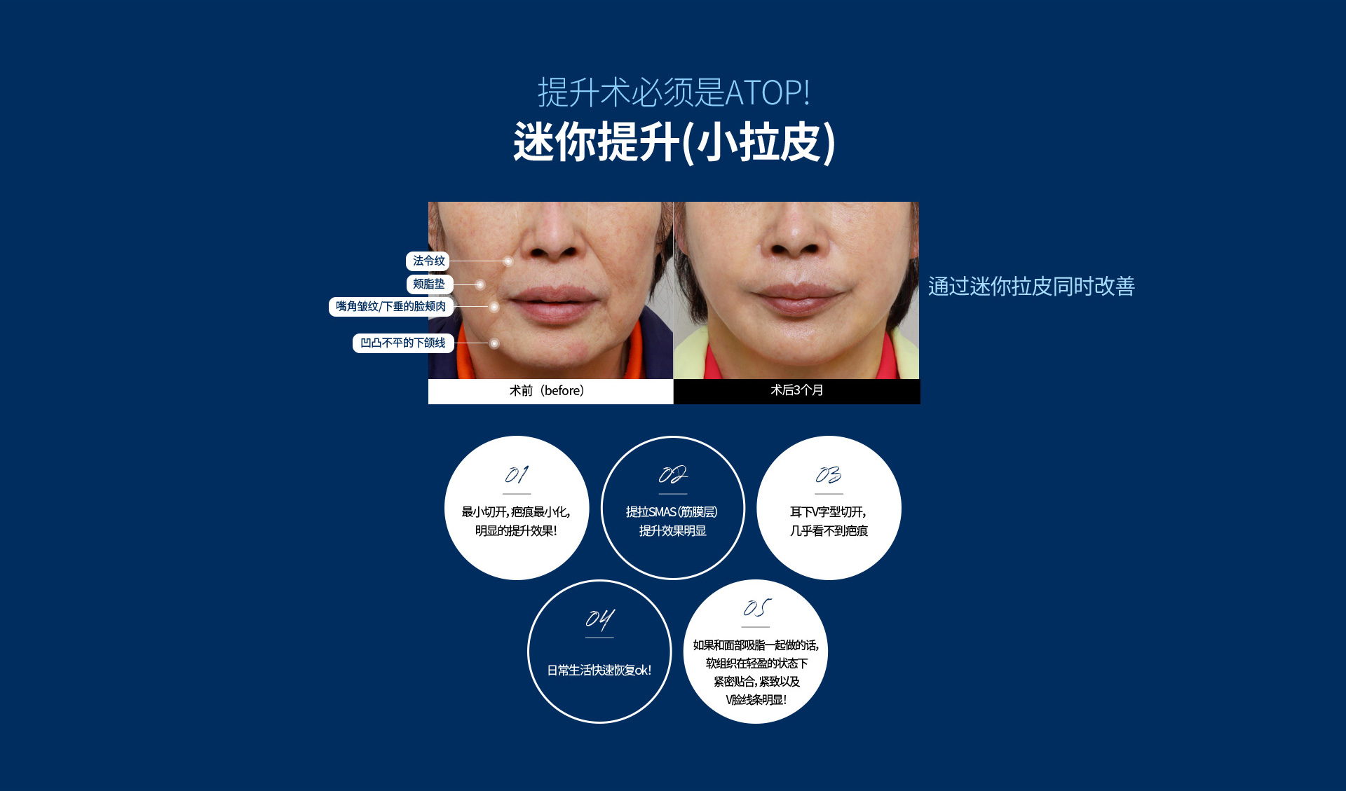 심술보리프팅