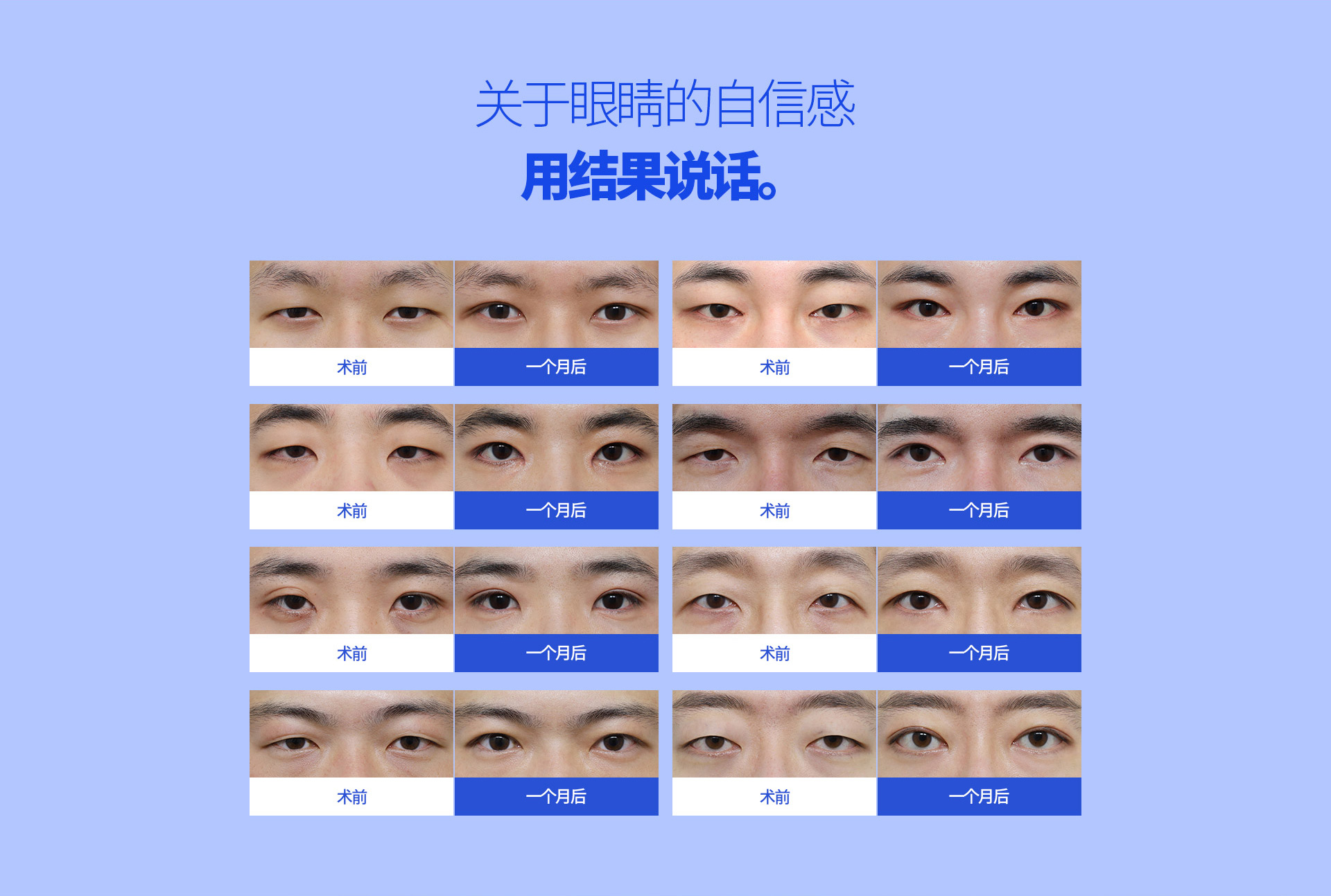 슬림라인 눈성형