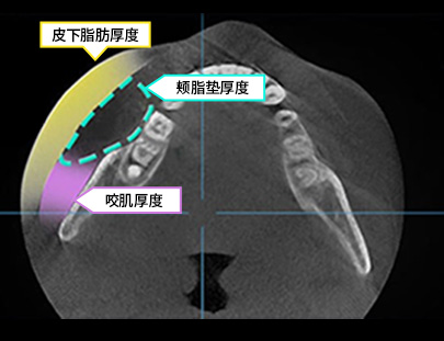 3D CT FIT 얼굴지방흡입