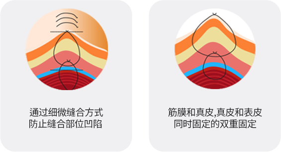 입꼭지성형