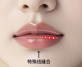 입술축소수술